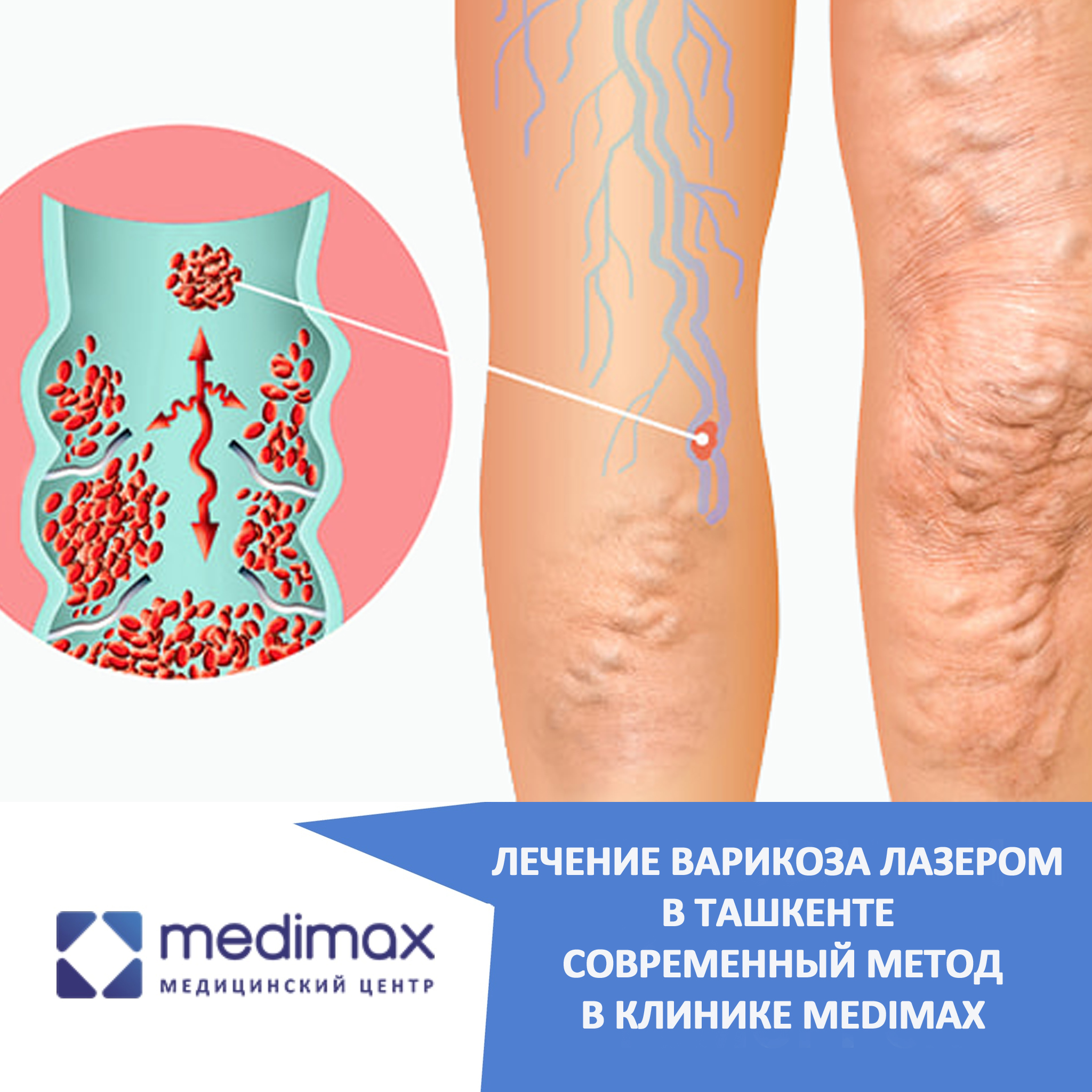 Лечение варикоза лазером в Ташкенте — современный метод в клинике Medimax